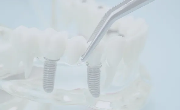 Dental Bridges