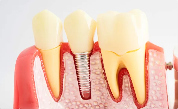 Dental Implants